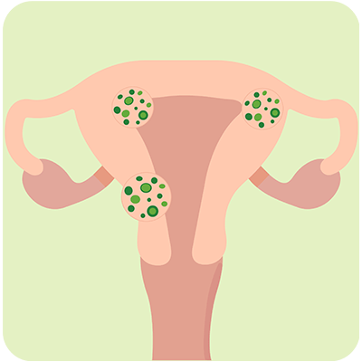 uterine fibroids